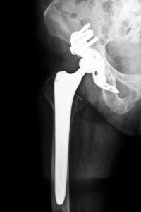 New Orleans DePuy Hip Recall Lawyer